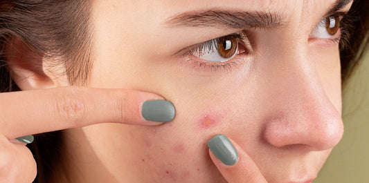 5 Effectieve Tips voor het beheren van adolescente Acne: uw weg naar een duidelijkere huid